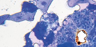 L’odontoiatria e le reazioni avverse a farmaci delle mucose orali L’odontoiatria e le reazioni avverse a farmaci delle mucose orali