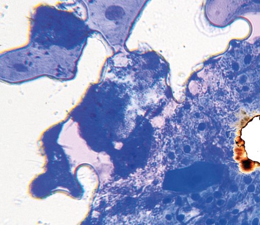 L’odontoiatria e le reazioni avverse a farmaci delle mucose orali