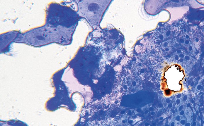 L’odontoiatria e le reazioni avverse a farmaci delle mucose orali L’odontoiatria e le reazioni avverse a farmaci delle mucose orali