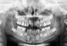 Gestione terapeutica di un paziente in crescita con scarsa igiene orale: trattamento pediatrico-ortodontico Fig. 1 Ortopantomografia: si evidenziava la presenza di elementi permanenti e decidui con trattamenti conservativi ed endodotontici.