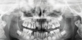 Gestione terapeutica di un paziente in crescita con scarsa igiene orale: trattamento pediatrico-ortodontico Fig. 1 Ortopantomografia: si evidenziava la presenza di elementi permanenti e decidui con trattamenti conservativi ed endodotontici.