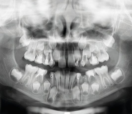 Gestione terapeutica di un paziente in crescita con scarsa igiene orale: trattamento pediatrico-ortodontico Fig. 1 Ortopantomografia: si evidenziava la presenza di elementi permanenti e decidui con trattamenti conservativi ed endodotontici.
