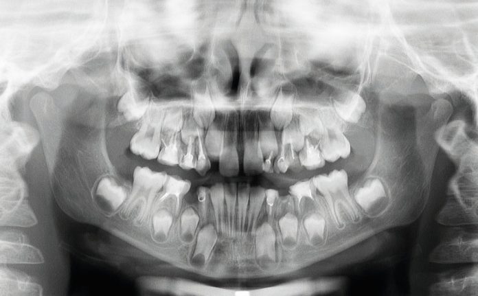 Fig. 1 Ortopantomografia: si evidenziava la presenza di elementi permanenti e decidui con trattamenti conservativi ed endodotontici. Fig. 1 Ortopantomografia: si evidenziava la presenza di elementi permanenti e decidui con trattamenti conservativi ed endodotontici.