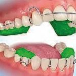 Fig. 1 Dispositivo Twin Block.