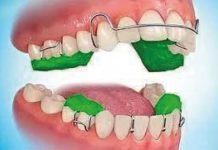 Fig. 1 Dispositivo Twin Block.