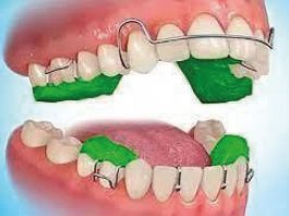 Fig. 1 Dispositivo Twin Block.