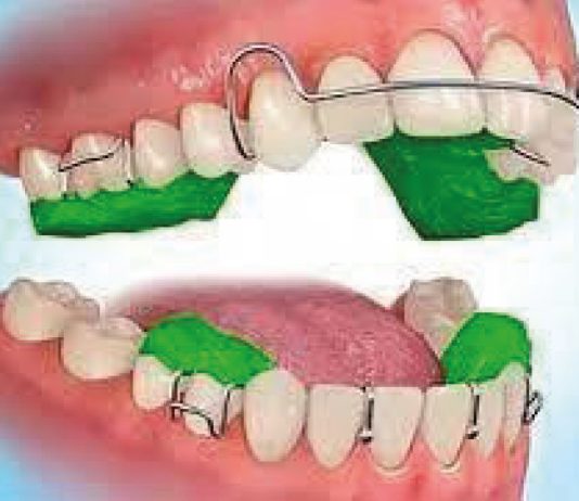 Fig. 1 Dispositivo Twin Block.