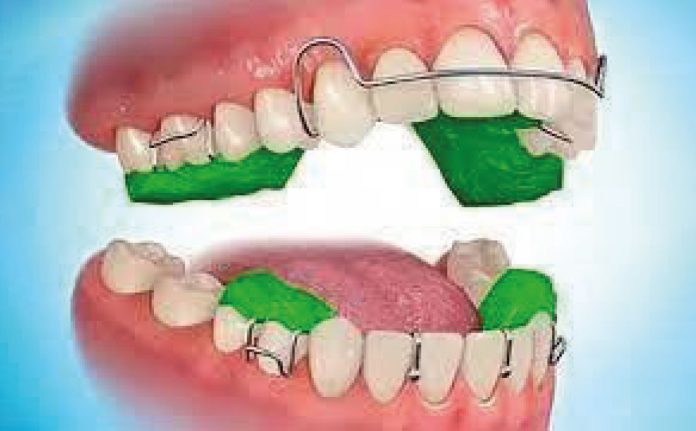 Fig. 1 Dispositivo Twin Block.
