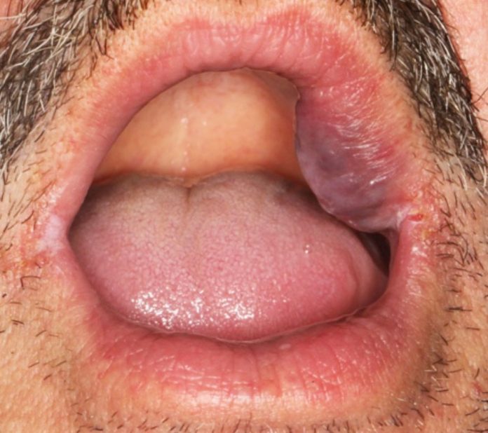 Fig. 1 Malformazione venosa (MV) dell’emi-labbro superiore.