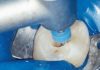 Fig. 1A Le tre fasi fondamentali del trattamento endodontico: sagomatura.