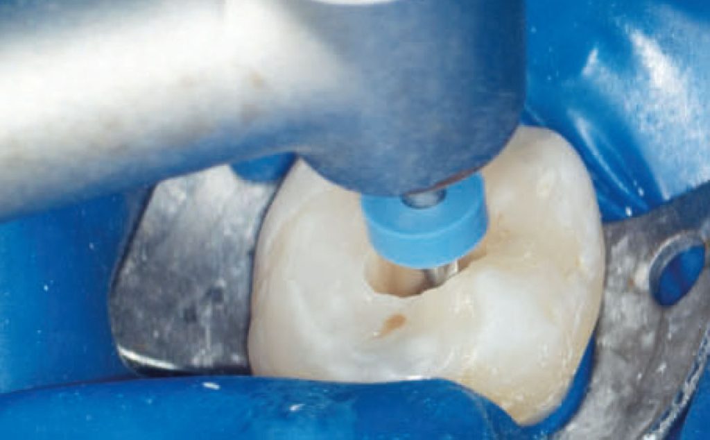 Fig. 1A Le tre fasi fondamentali del trattamento endodontico: sagomatura.