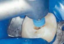 Fig. 1A Le tre fasi fondamentali del trattamento endodontico: sagomatura.