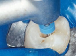 Fig. 1A Le tre fasi fondamentali del trattamento endodontico: sagomatura.