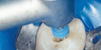 Fig. 1A Le tre fasi fondamentali del trattamento endodontico: sagomatura.