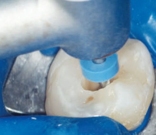 Fig. 1A Le tre fasi fondamentali del trattamento endodontico: sagomatura.