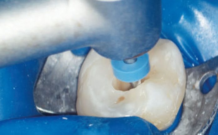 Fig. 1A Le tre fasi fondamentali del trattamento endodontico: sagomatura.
