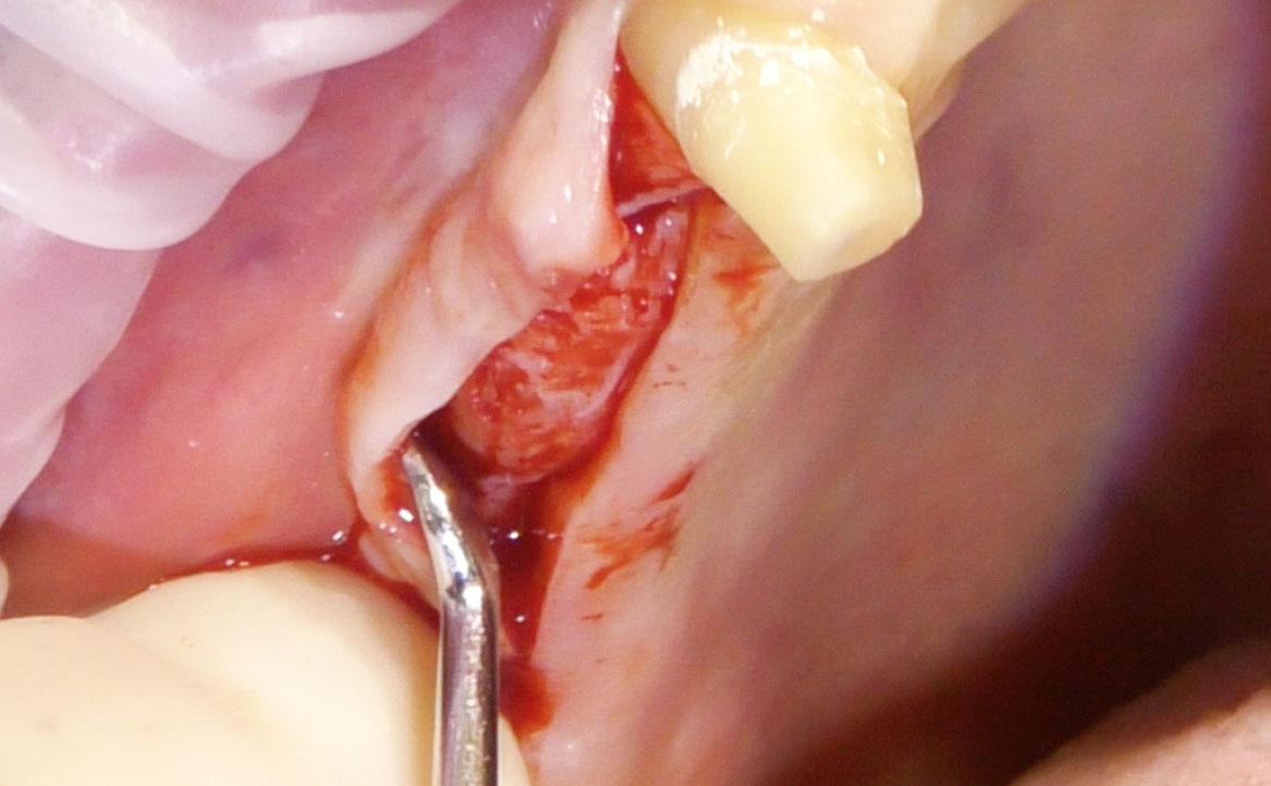 Fig. 2 Scollamento vestibolare del lembo.