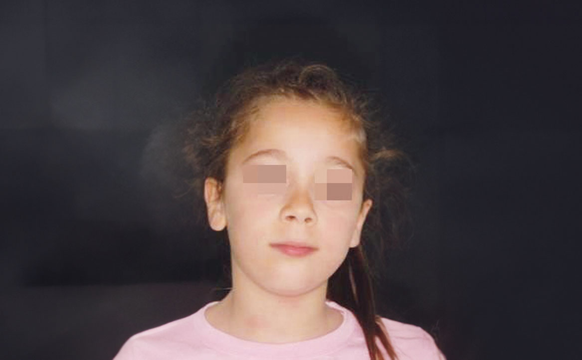 Fig. 2 Fotografia extra orale del volto: frontale a riposo.