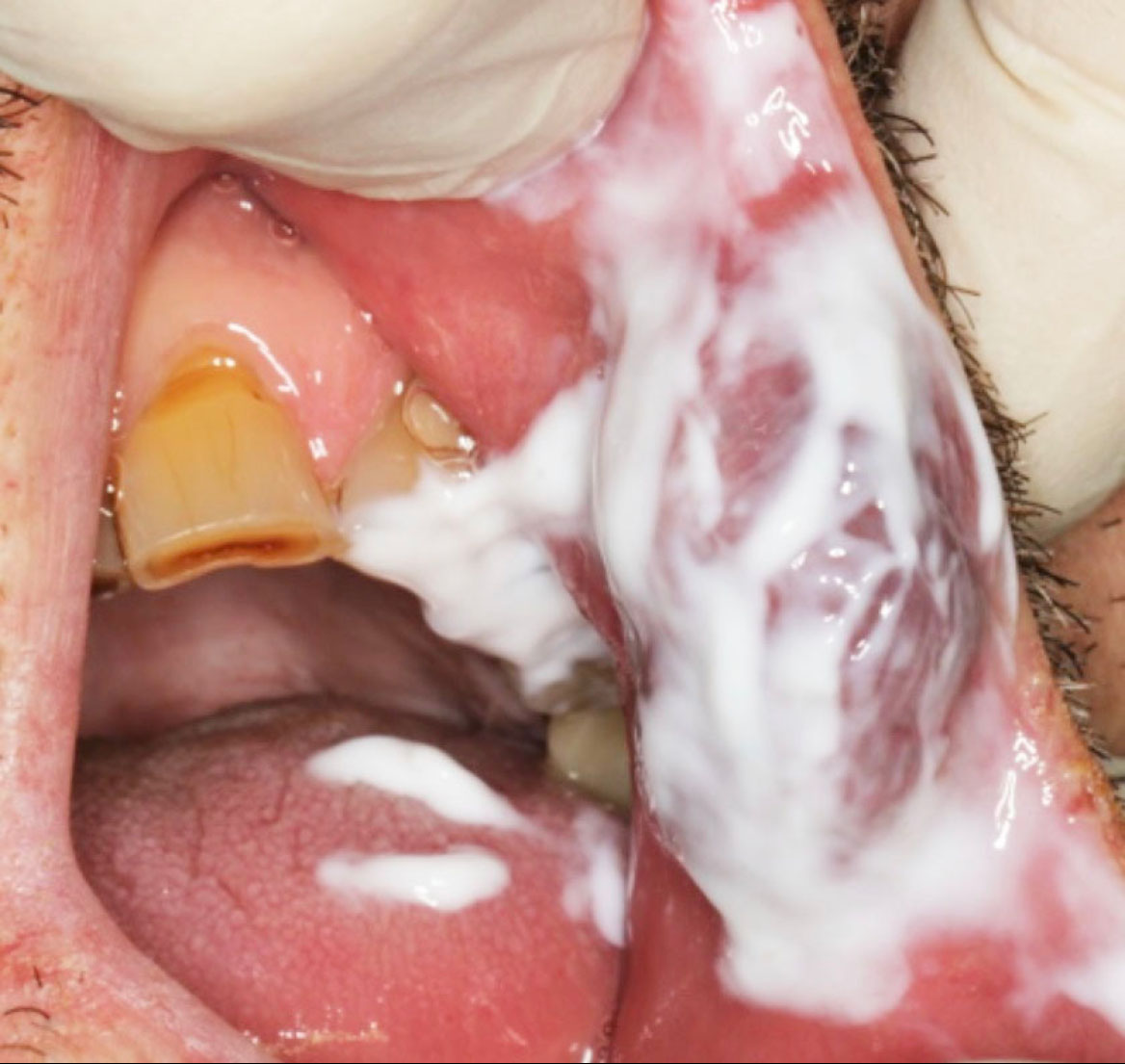 Fig. 2 Applicazione anestetico di superficie.