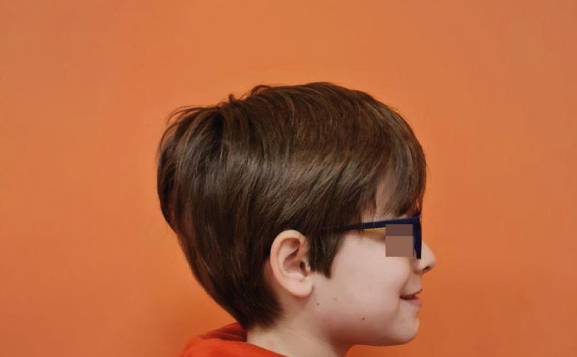 Fig. 1B Foto laterale iniziale.