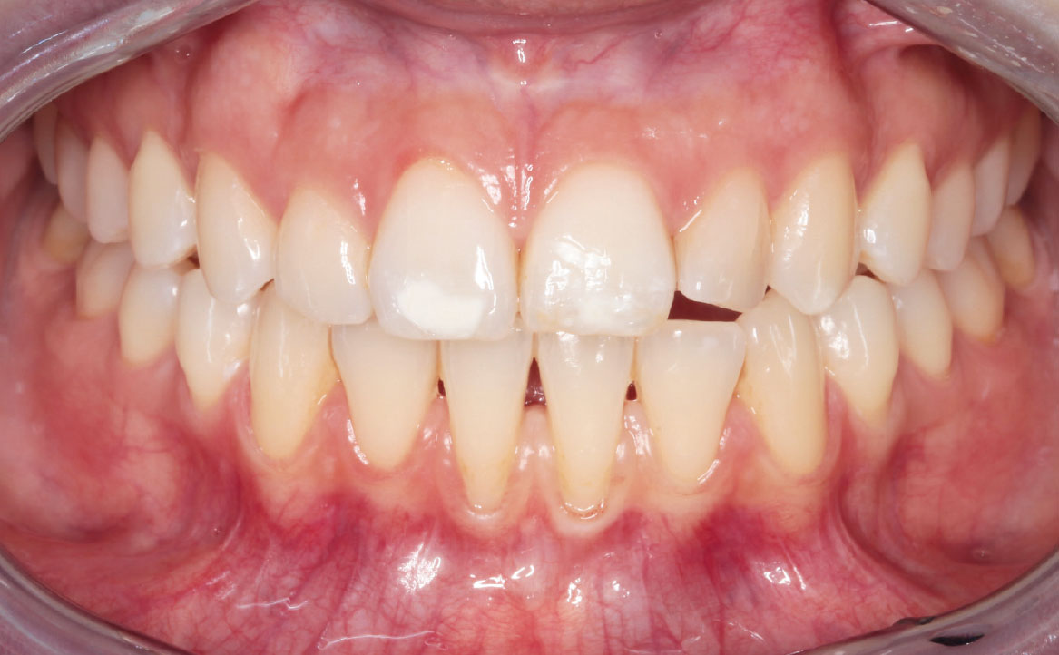 Fig. 2 Dettaglio vestibolo mandibolare anteriore.