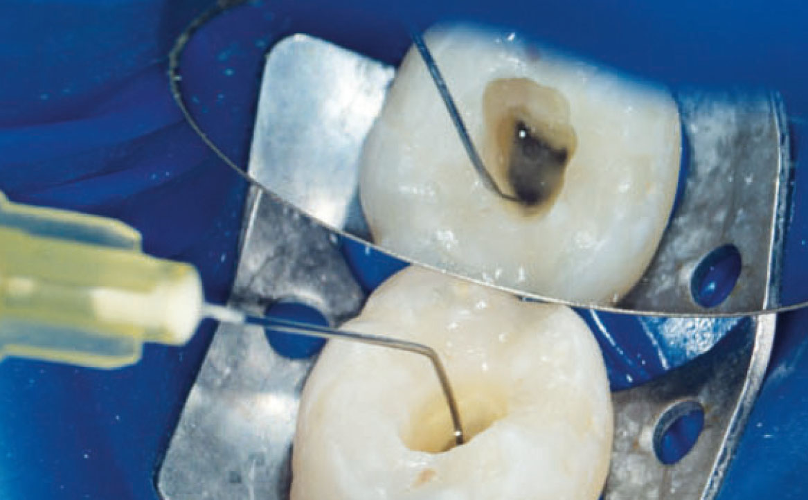 Fig. 1B Le tre fasi fondamentali del trattamento endodontico: irrigazione.