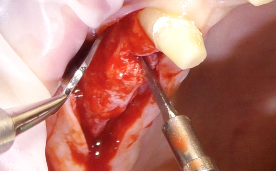 Fig. 3 Scollamento palatale e scheletrizzazione di parte del processo alveolare.