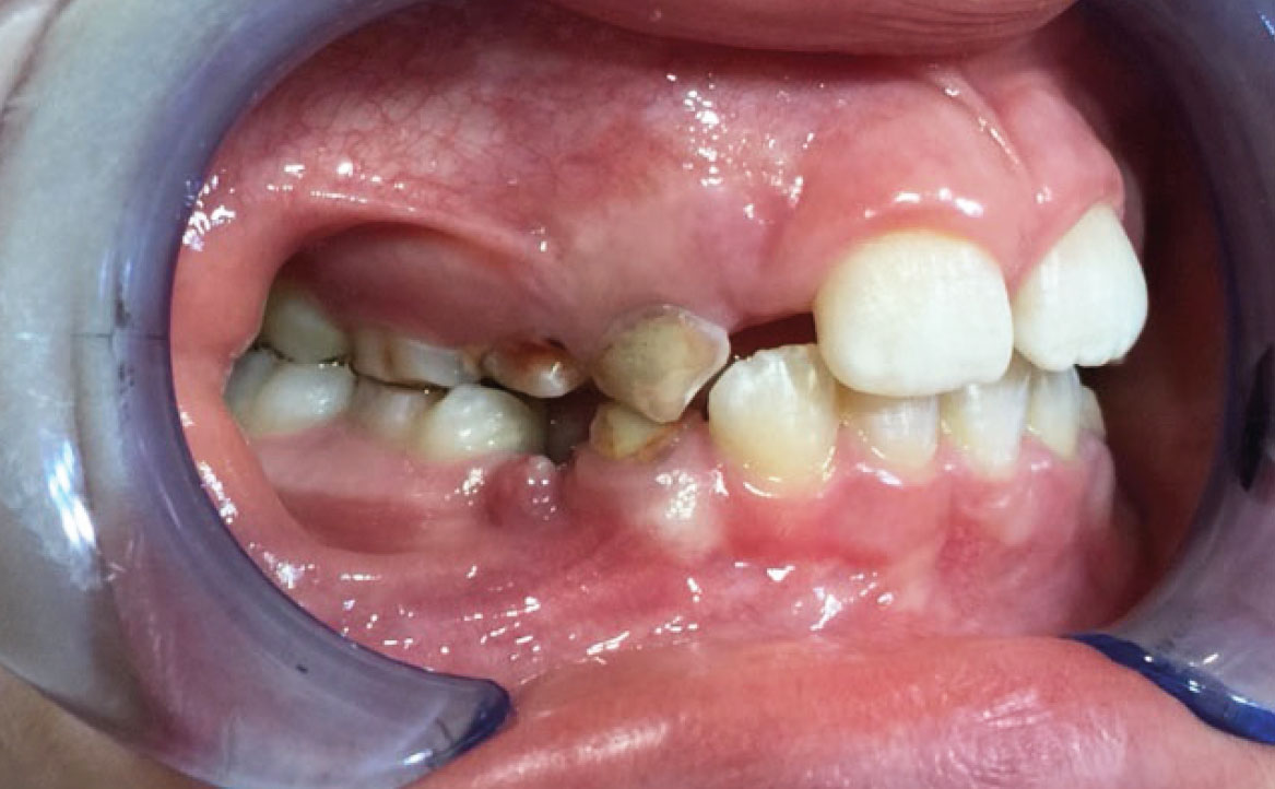 Fig. 3A Foto intraorale laterale di destra.