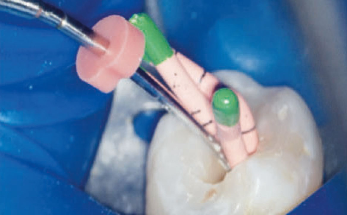 Fig. 1C Le tre fasi fondamentali del trattamento endodontico: otturazione.