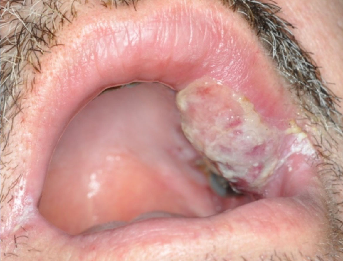 Fig. 4 Risultato a cinque giorni: area di rimaneggiamento della mucosa successivo alla fotocoagulazione.