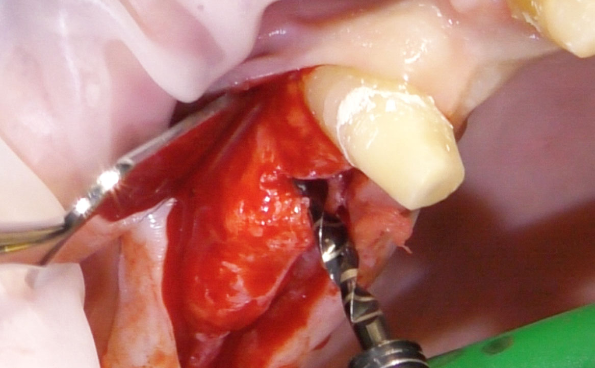 Fig. 4 Preparazione del sito implantare con frese calibrate (1).
