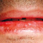 Fig. 1A Caso clinico di eritema multiforme in un giovane paziente correlato all’assunzione di FANS, caratterizzato dal coinvolgimento del vermiglio del labbro inferiore e della lingua.