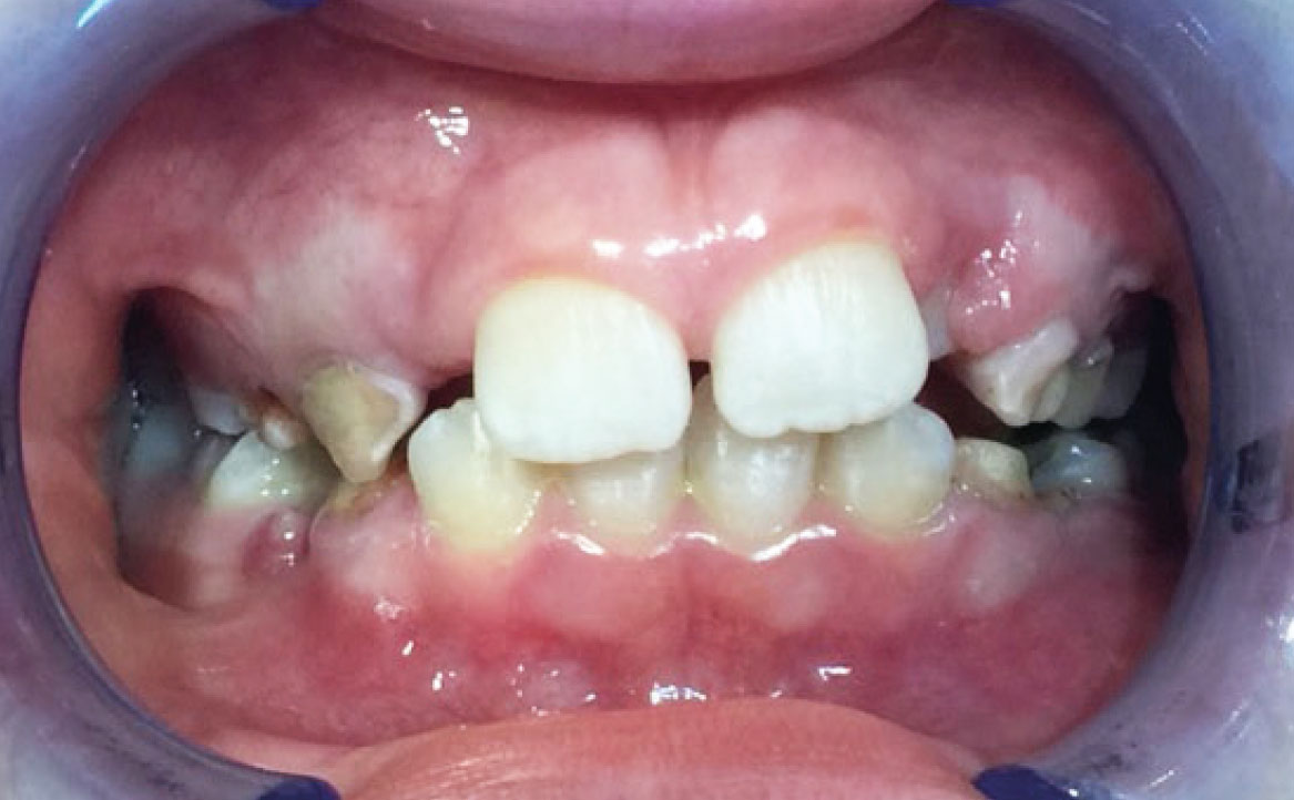 Fig. 3B Foto intraorale frontale.