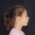 Fig. 4 Fotografia extra orale del volto: profilo.