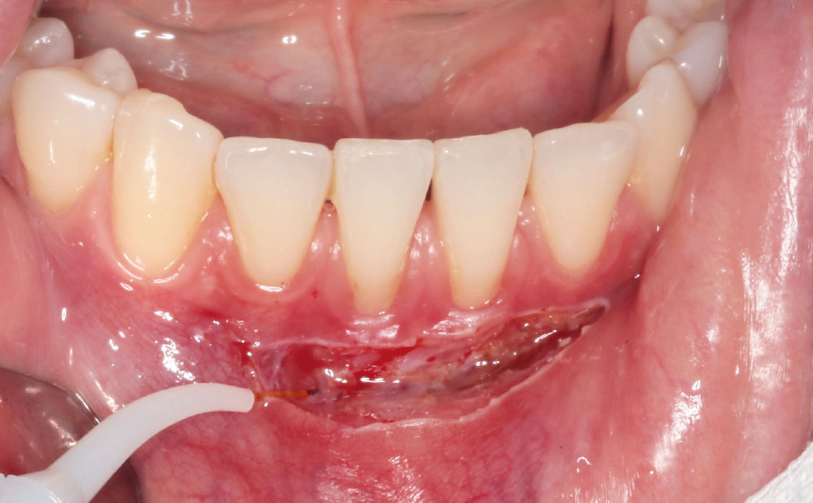 Fig. 4 Incisione parallela alla cresta alveolare eseguita con laser Nd:YAG (1064nm).