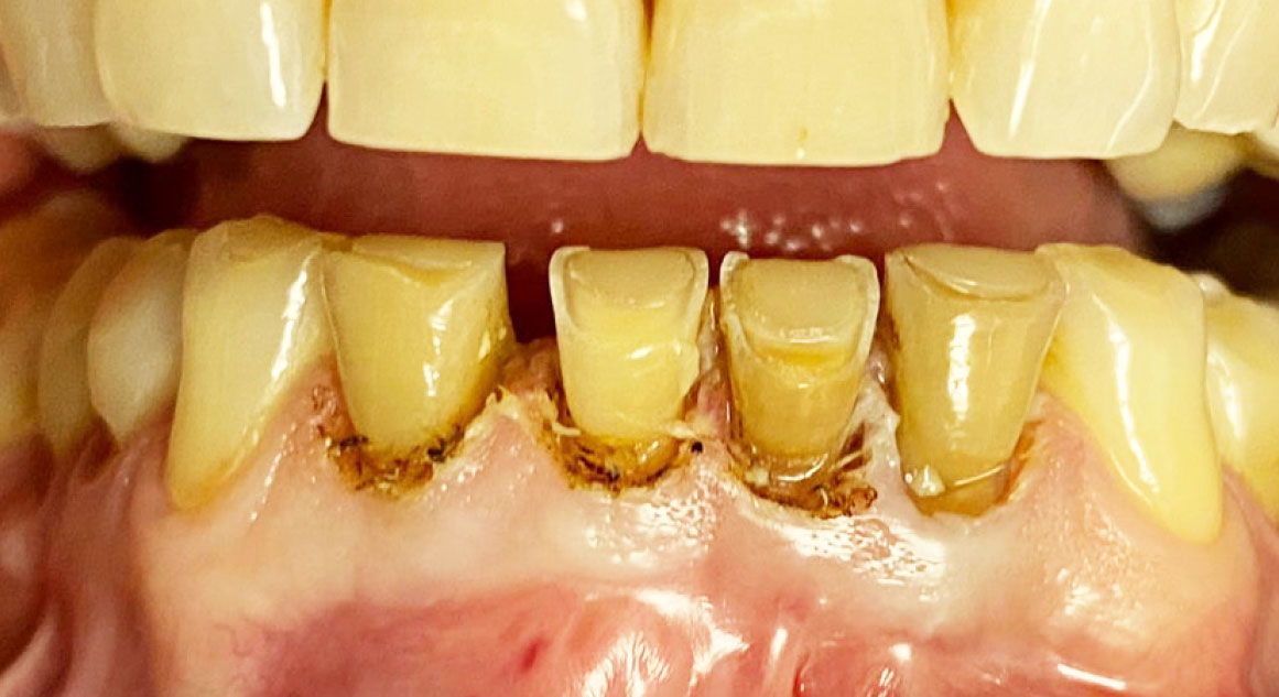 Fig. 4 Gengivectomia laser assistita.