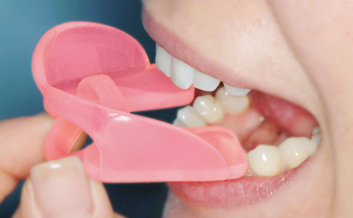 Fig. 1 Dettagli dell’inserimento e posizionamento della lingua allo spot mediante il bite anello linguale RI.P.A.RA. Il bite RI.P.A.RA. è un dispositivo di riposizionamento rieducativo funzionale che modifica la posizione e la postura della mandibola, dei condili, della lingua e quindi di tutto il sistema di vettori e di forze dei muscoli masticatori. Non è un semplice spessore che si inserisce tra i denti. Il paziente non deve portare il bite RI.P.A.RA solo in modo statico e passivo ma deve eseguire specifici esercizi in modo attivo con il bite in bocca, come descritto nel testo.