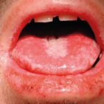 Fig. 1B Caso clinico di eritema multiforme in un giovane paziente correlato all’assunzione di FANS, caratterizzato dal coinvolgimento del vermiglio del labbro inferiore e della lingua.