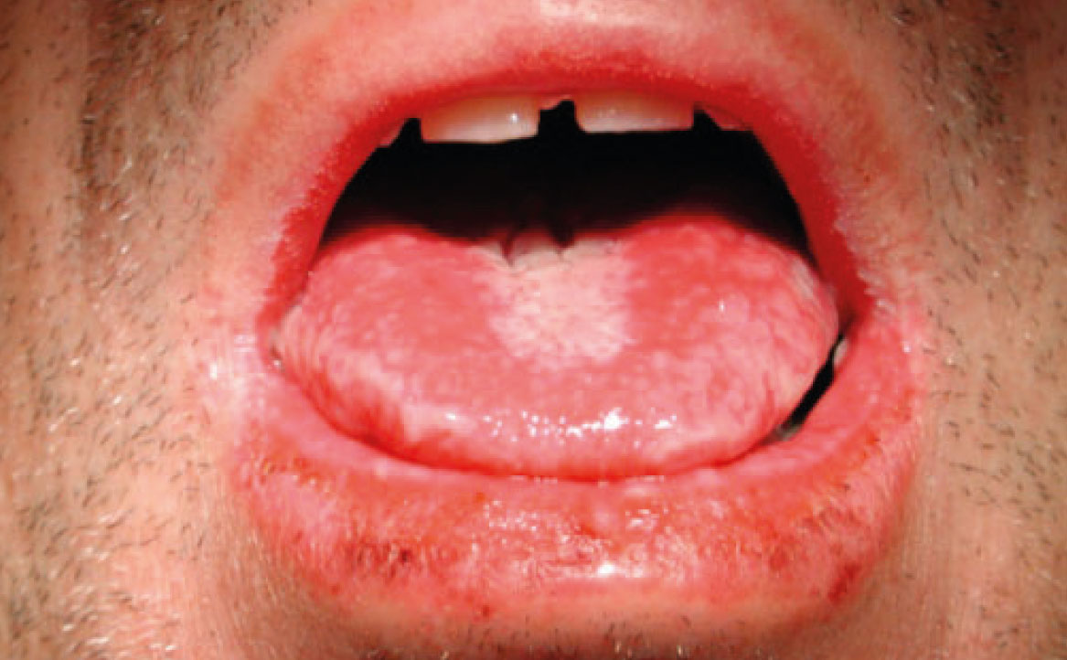 Fig. 1B Caso clinico di eritema multiforme in un giovane paziente correlato all’assunzione di FANS, caratterizzato dal coinvolgimento del vermiglio del labbro inferiore e della lingua.