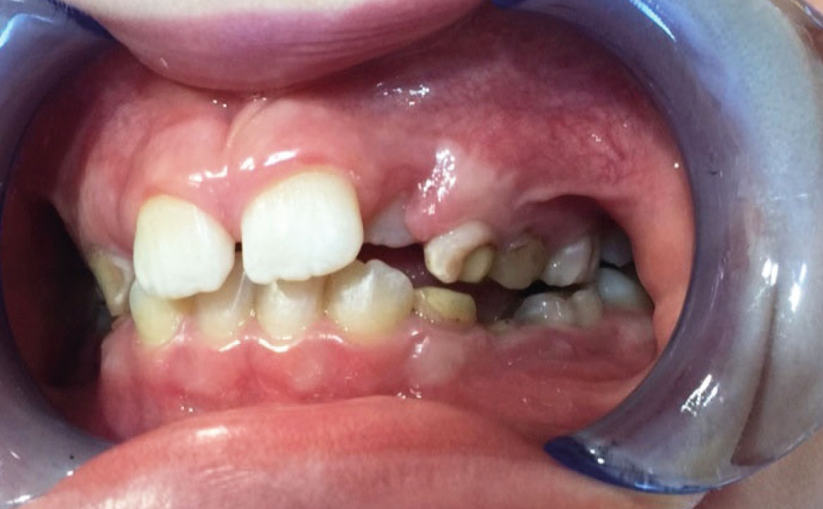 Fig. 3C Foto intraorale laterale di sinistra.