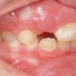 Fig. 5 Fotografia intra orale: laterale destra.