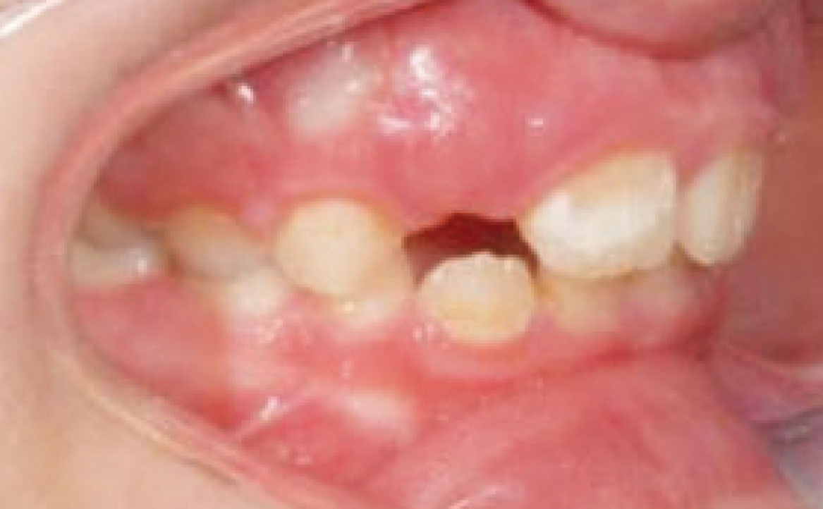 Fig. 5 Fotografia intra orale: laterale destra.