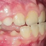 Fig. 4A Foto intraorale in massima intercuspidazione.