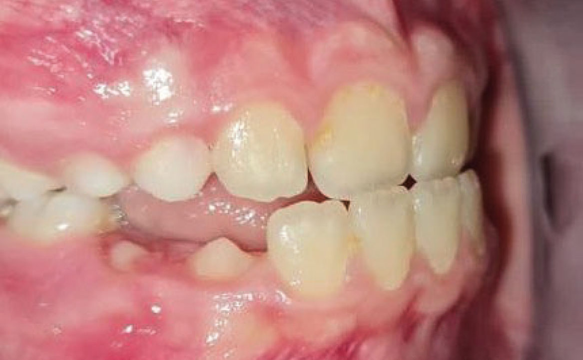 Fig. 4A Foto intraorale in massima intercuspidazione.