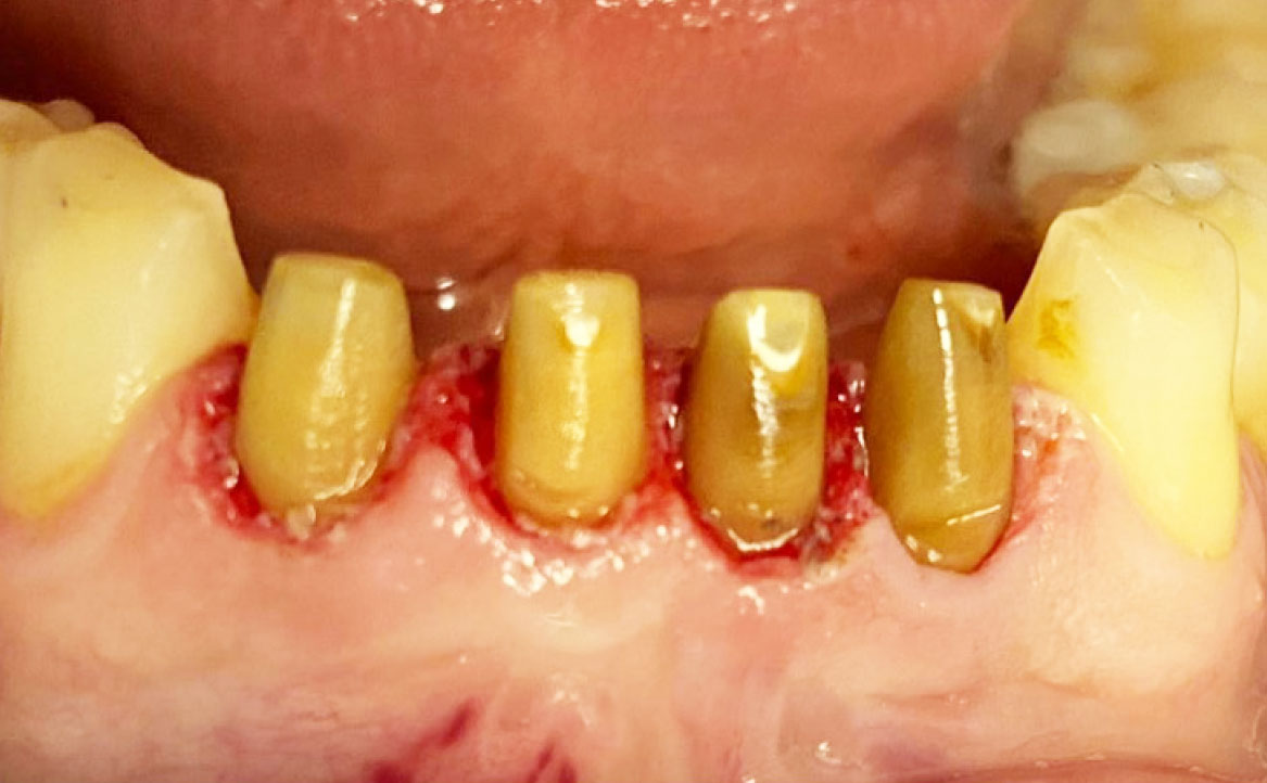 Fig. 5 Preparazione dentale post gengivectomia.