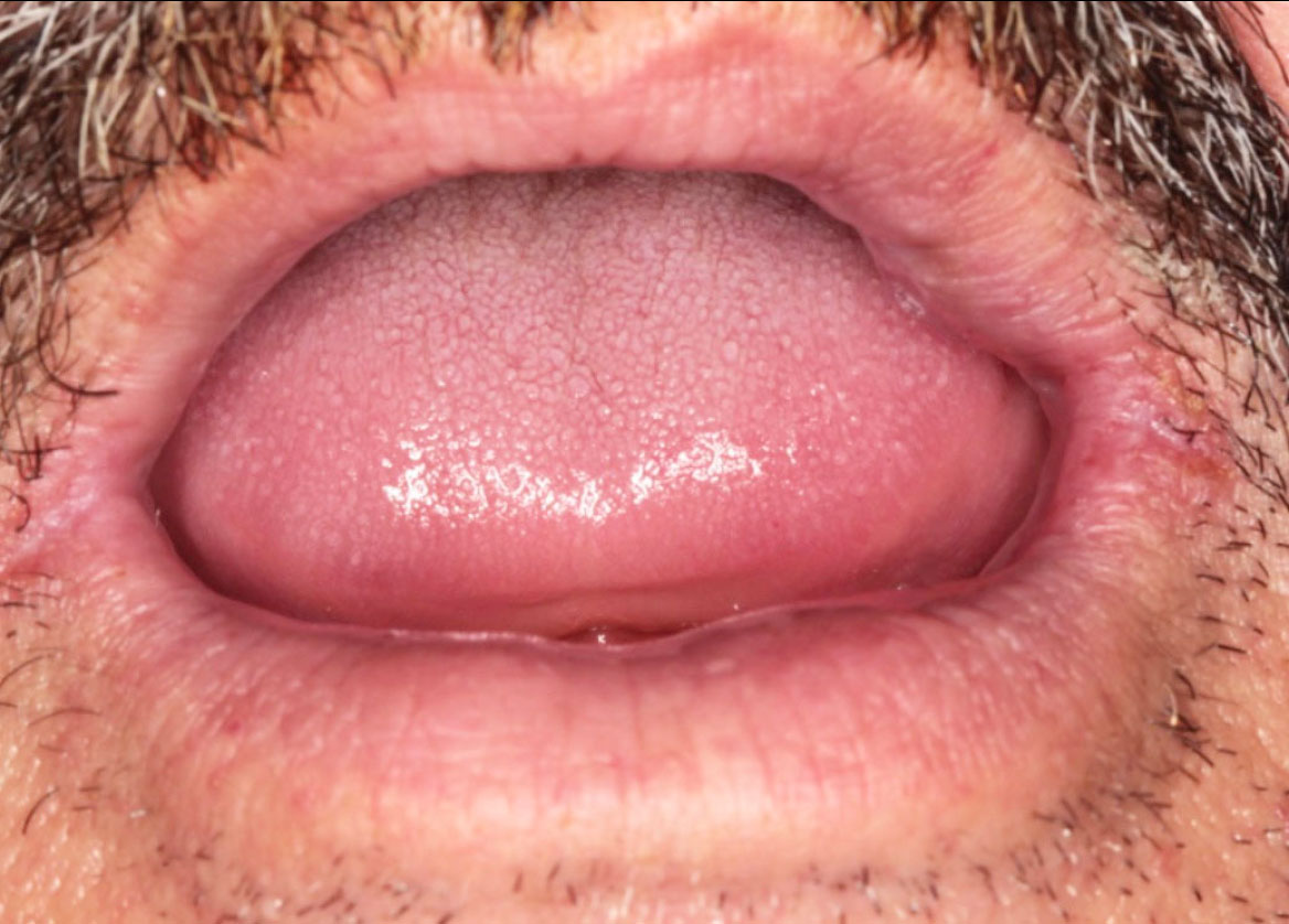 Fig. 6 Guarigione completa con assenza di retrazione cicatriziale e perfetto man-tenimento dell’euritmia del profilo labiale.