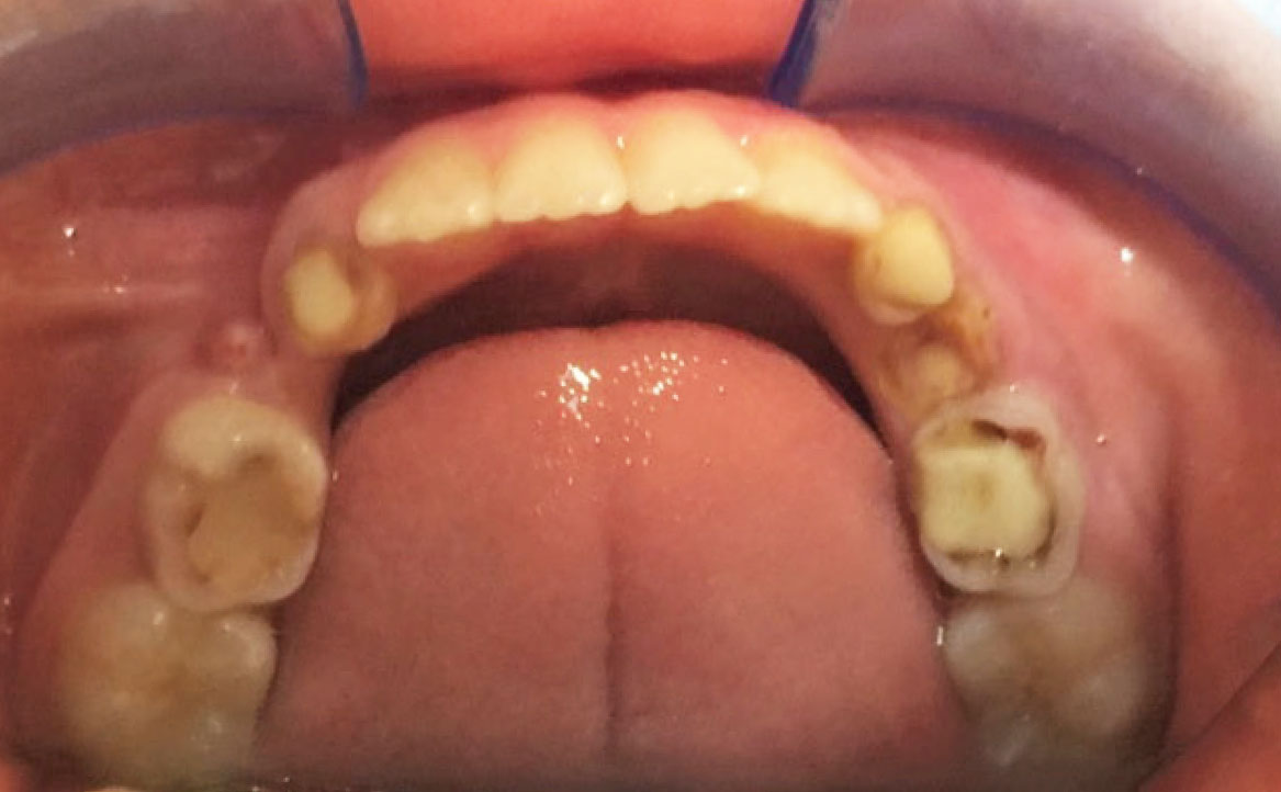 Fig. 3D Foto intraorale arcata inferiore.