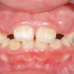 Fig. 6 Fotografia intra orali: frontale.