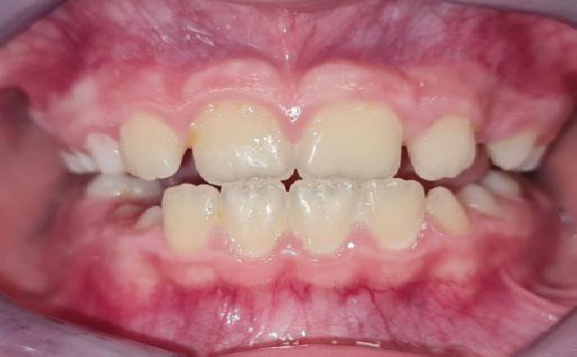 Fig. 4B Foto intraorale in massima intercuspidazione.