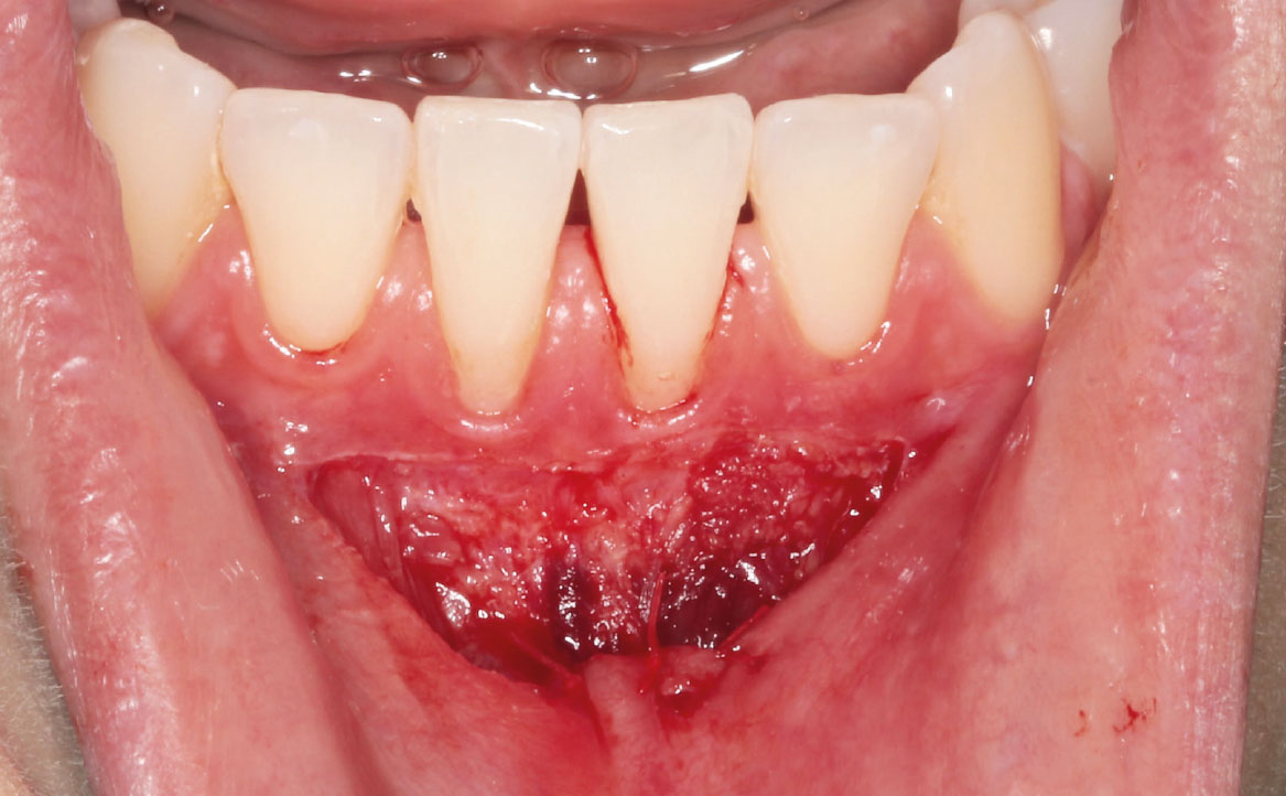 Fig. 6 Punti di sutura applicati per fissare la mucosa orale alla sottomucosa.